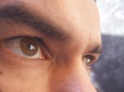 Oči a štítna žľaza – endokrinná orbitopatia