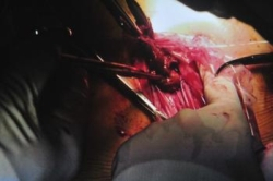 V Bratislave dnes zrealizovali unikátne operácie pečene