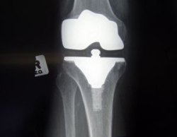 Osteoartróza - keď bolia kĺby