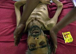 Na tuberkulózu zomiera denne vo svete 4400 osôb