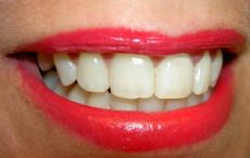 Bielenie zubov patrí do rúk zubných lekárov