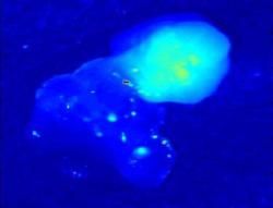 Bezpečnejšie operácie štítnej žľazy