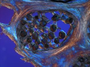 Osteoporóza je epidémiou tretieho tisícročia