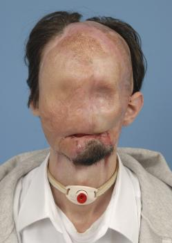 Muž s prvou transplantáciou celej tváre v USA predstúpil pred verejnosť