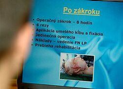 Chirurgovia FNLP obnovili pohyblivosť sánky pacientky po 20 rokoch