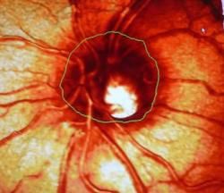 Galukóm - zelený zákal