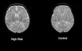 Schizofréniu možno rozpoznať už v kolíske