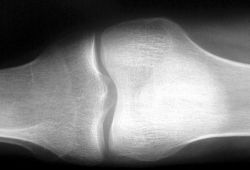 Reumatoidná artritída