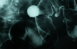 Rakovina hrubého čreva