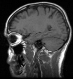 Následky ochorení mozgu sa v porovnaní s minulosťou veľmi nezmenili