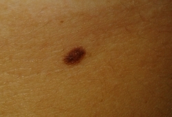 Odstránenie znamienok