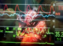 Úmrtnosť na kardiovaskulárne ochorenia v SR klesá, najmä na akútne infarkty