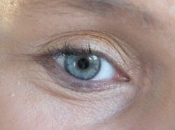 Oči a botulotoxín - aplikácia v medicínskych indikáciach