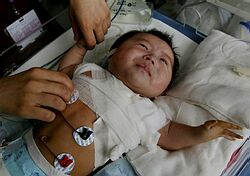 Lekári úspešne odstrálili čínskemu chlapcovi tretiu ruku