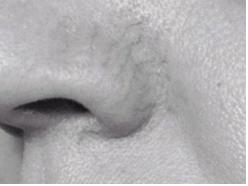 Rozšírené cievky - liečba laserom a intenzívnym pulzným svetlom