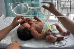 V Číne sa narodili siamské dvojčatá s jedným telom a dvoma hlavami
