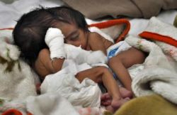 Pakistan: Lekári rozhodujú o oddelení dvojčiat spojených hlavami