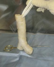 Dvom pacientkam s rakovinou úspešne transplantovali priedušnicu novým postupom