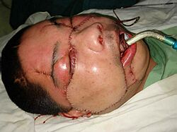 Čínski lekári vykonali druhú transplantáciu tváre na svete