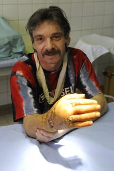 Považskobystrickí chirurgovia zachránili pacientovi odrezanú ruku