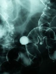 Črevná nepriechodnosť