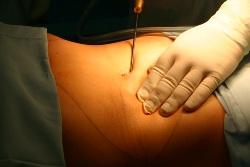 Novinka: Extra WAL liposukcia - odsávanie tuku vodným lúčom!