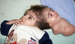 Rok po operácii zomrelo v Egypte "dvojhlavé" dievčatko