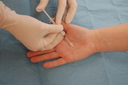 Nadmerné potenie - príčiny a možnosti liečby