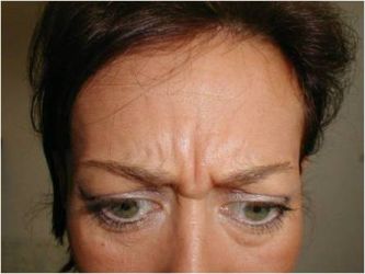 Je veľa spôsobov ako sa zbaviť vrások