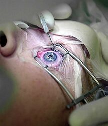 Na rímskej klinike Umberto sa zrejme kupčilo s očnými rohovkami