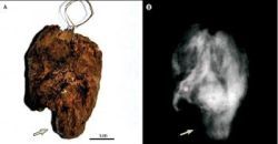 Stredoveká svätica Ružena Viterbská zomrela na srdcovú embóliu