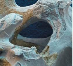 Osteoporóza - tichý zlodej kostí