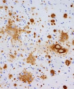 Krvný test na Alzheimerovu chorobu